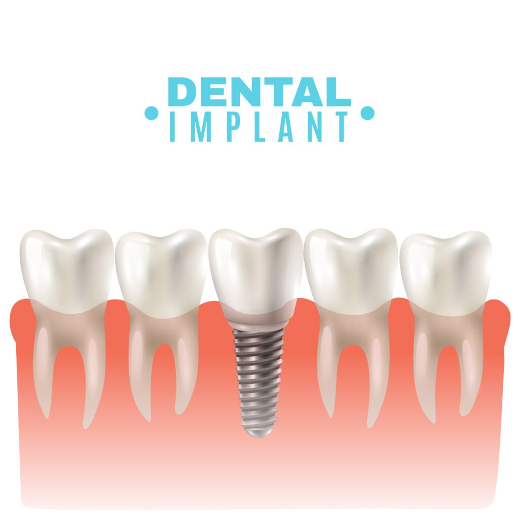 Dental implant ، زرع الاسنان في اسطنبول