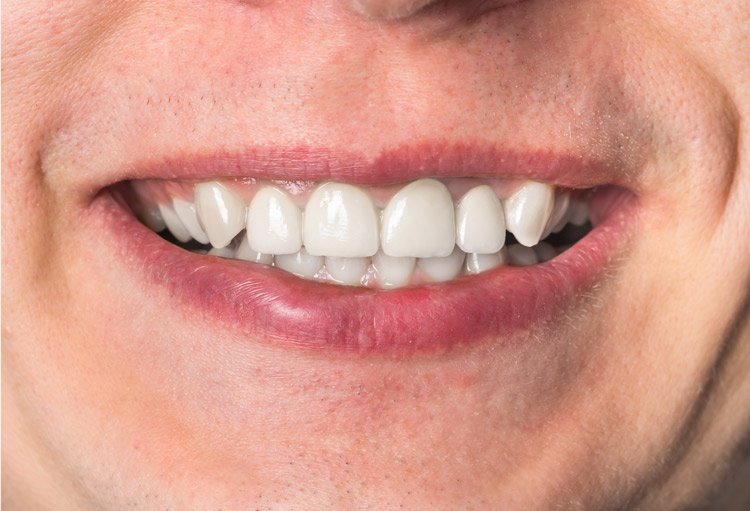 معالجة الاسنان بعد ، اسطنبول - تركيا